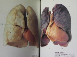 非喫煙者と喫煙者の肺